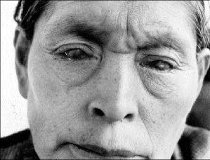 chiapas-tracoma-2